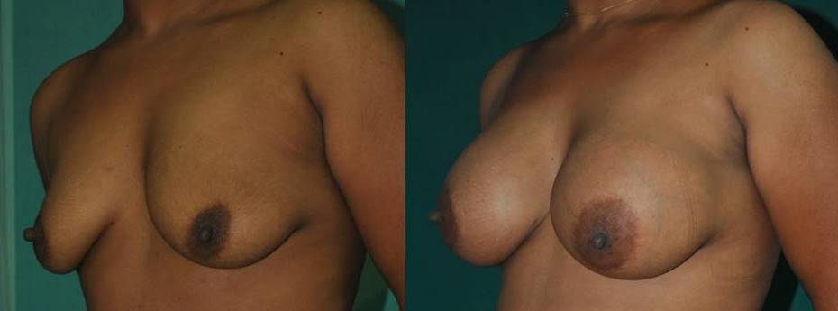 Breast implant result in India